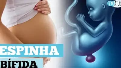 O que é e como prevenir a mielomeningocele?