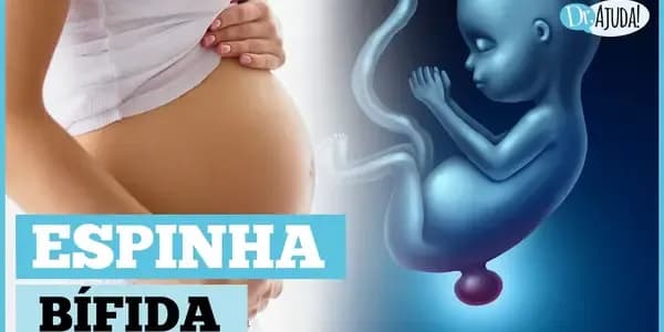 O que é e como prevenir a mielomeningocele?