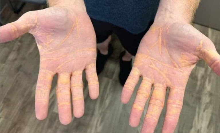 Alerta médico: Dieta carnívora extrema causa xantelasma em homem da Flórida