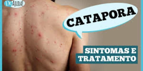 Dr. Ajuda: qual a relação da catapora com o herpes Zoster?
