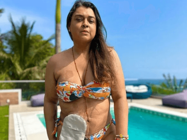 Preta Gil e a Colostomia: Vida Normal Após Cirurgia?