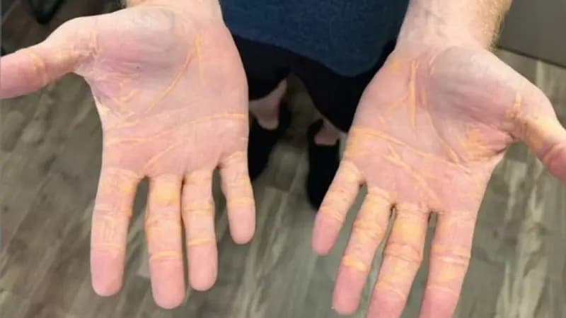 Alerta médico: Dieta carnívora extrema causa xantelasma em homem da Flórida